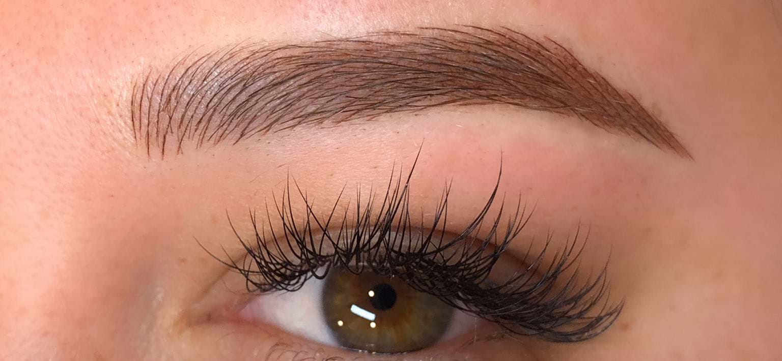 Alopecia-related eyebrow hair loss