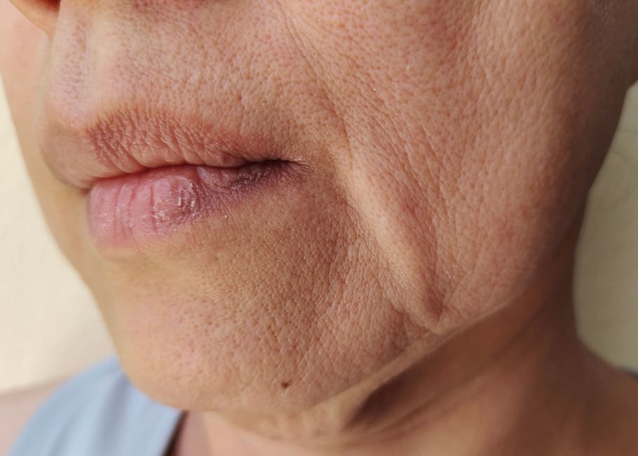 Sun damage UV ageing skin