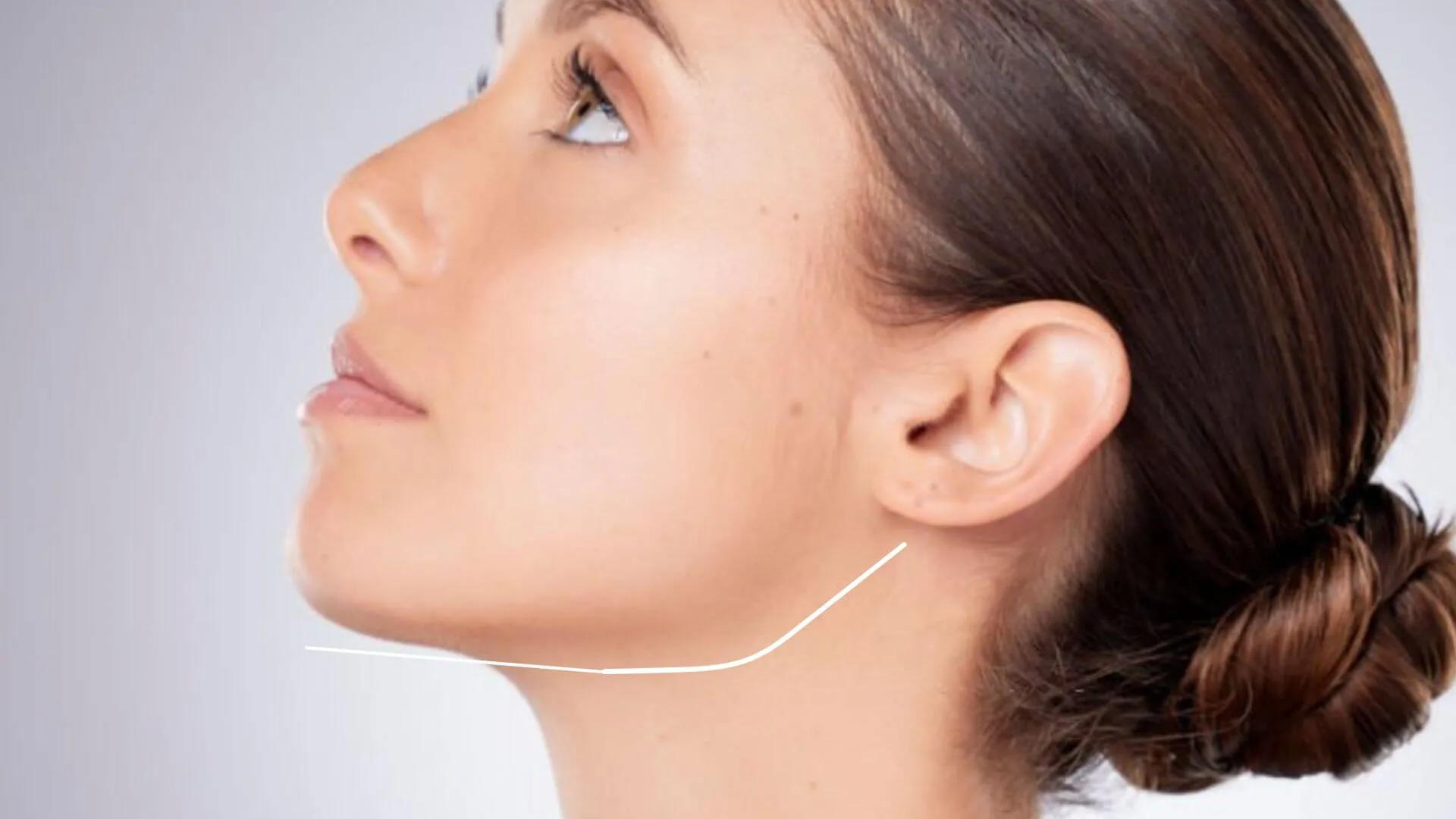Jowling and facial sagging with age