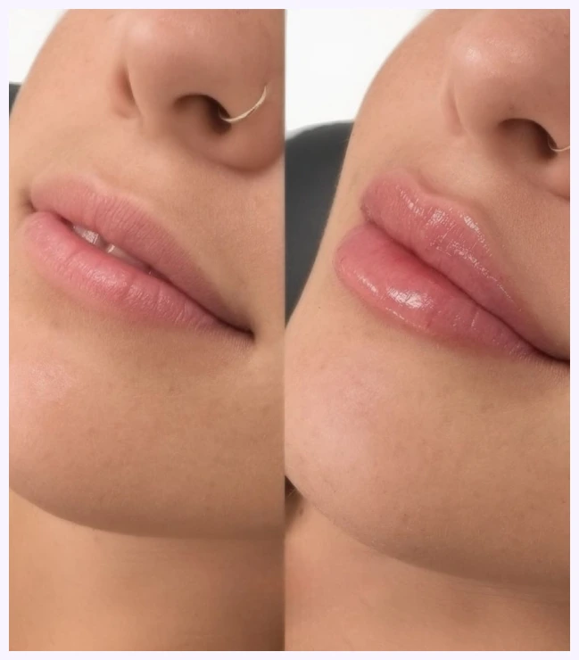 Lip filler enhancement treatment
