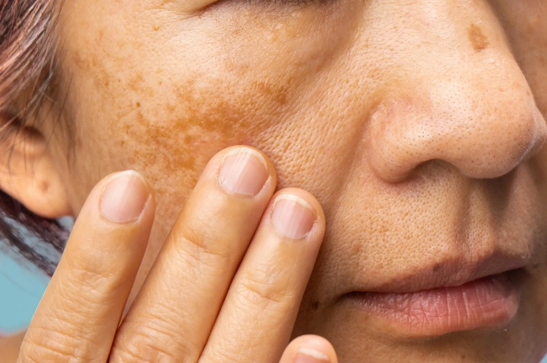Hormonal melasma skin condition