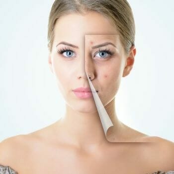 Non-ablative laser skin rejuvenation