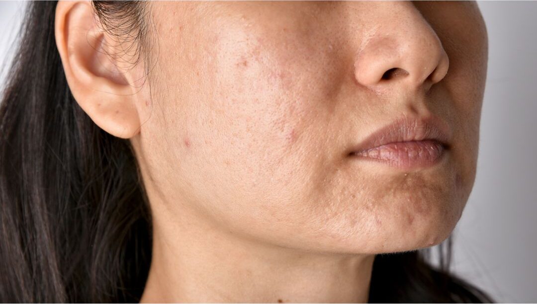 Age spots and skin ageing