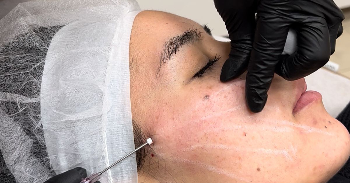 Facial volume depletion hollowing