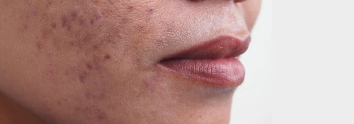 Post-inflammatory hyperpigmentation PIH
