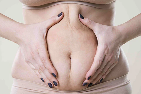 Genetic fat storage patterns body