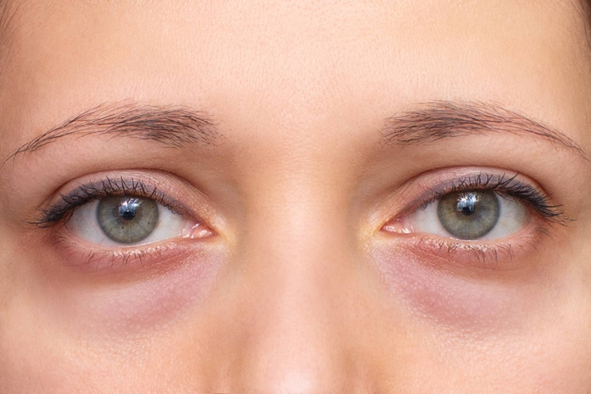 Under-eye hyperpigmentation