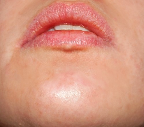 After acne treatment — clear skin