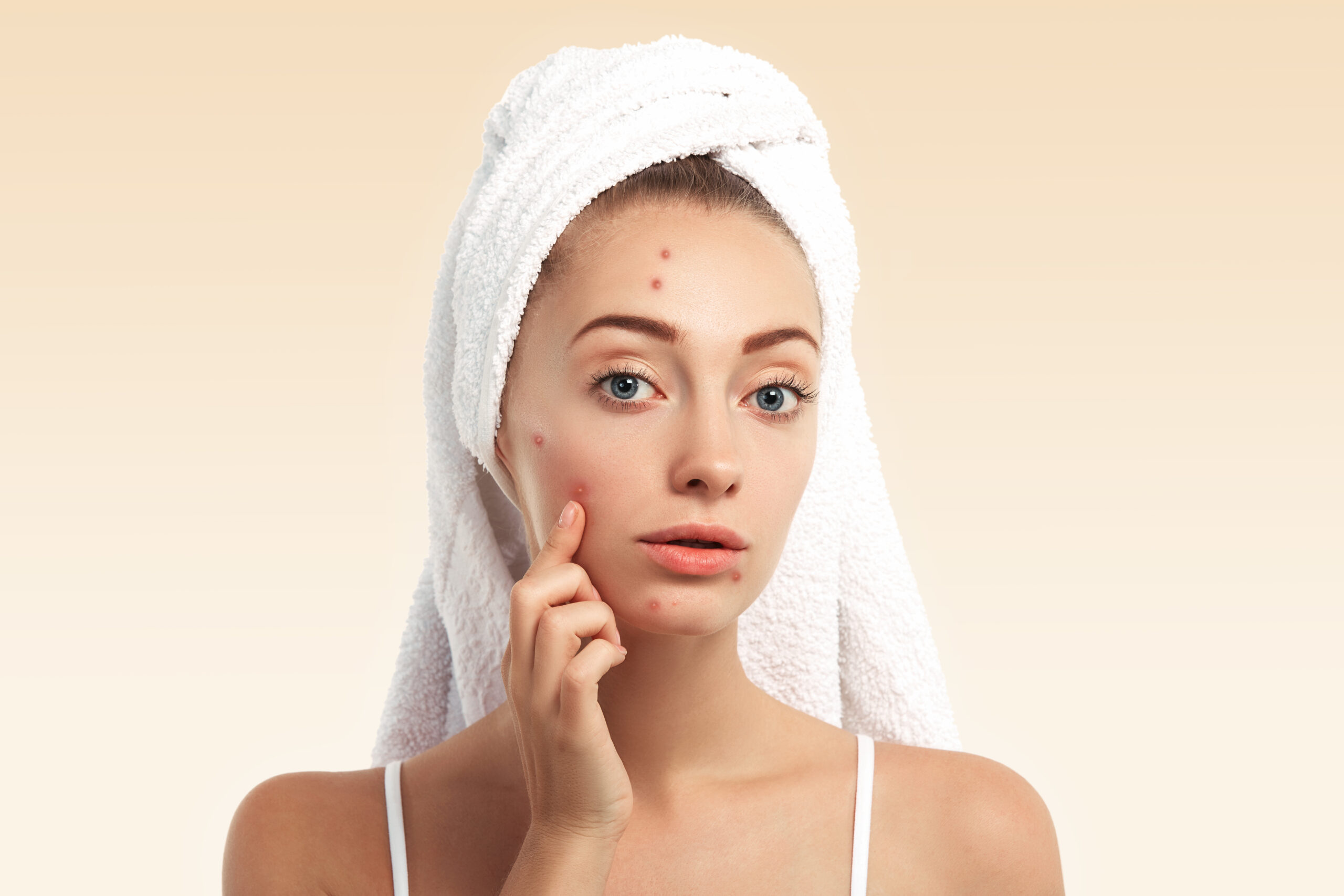 Clear, radiant skin after professional acne treatment
