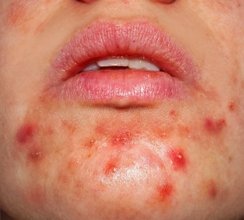 Before acne treatment