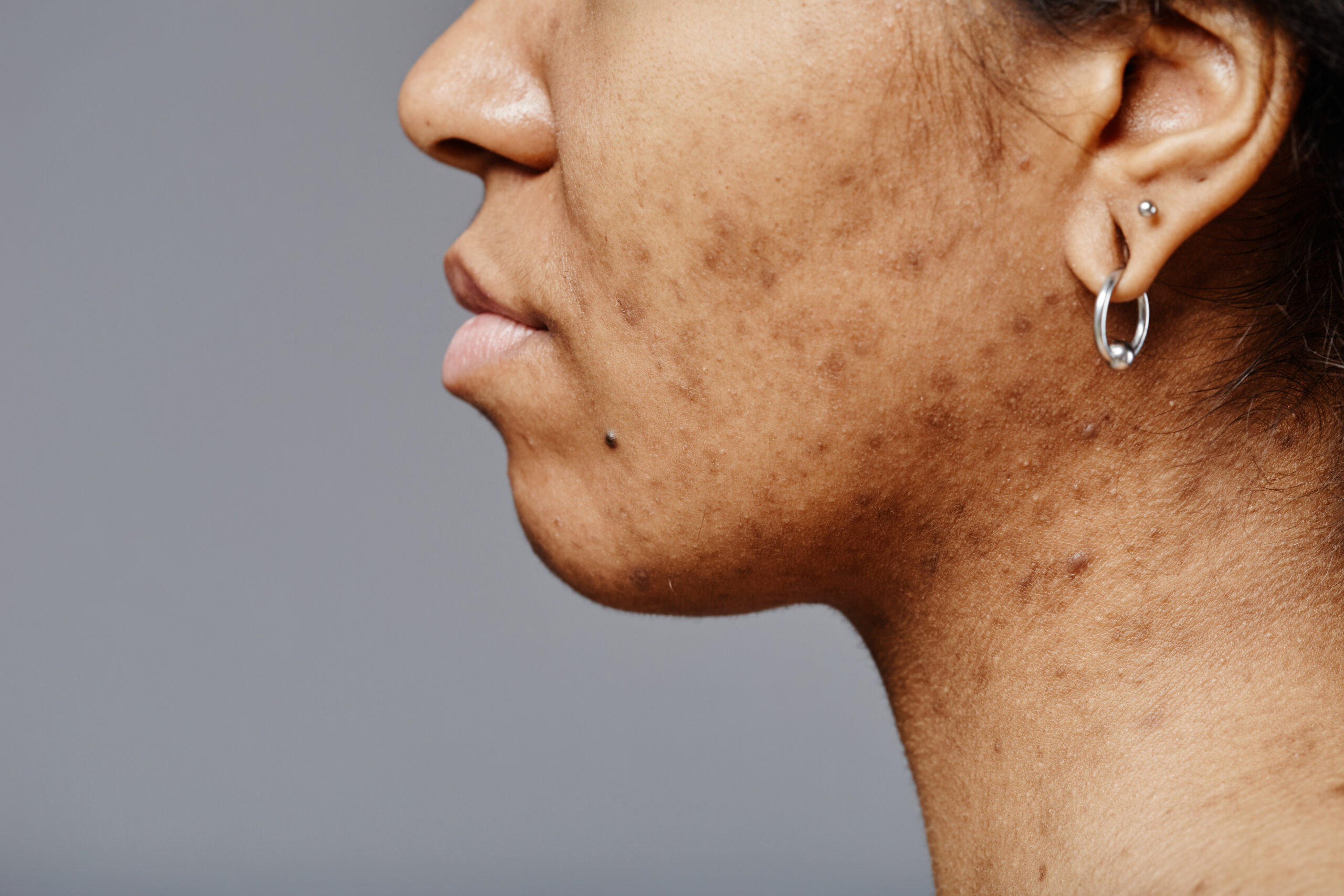 Acne Scar Treatment at Aliva Aesthetics Vijayawada