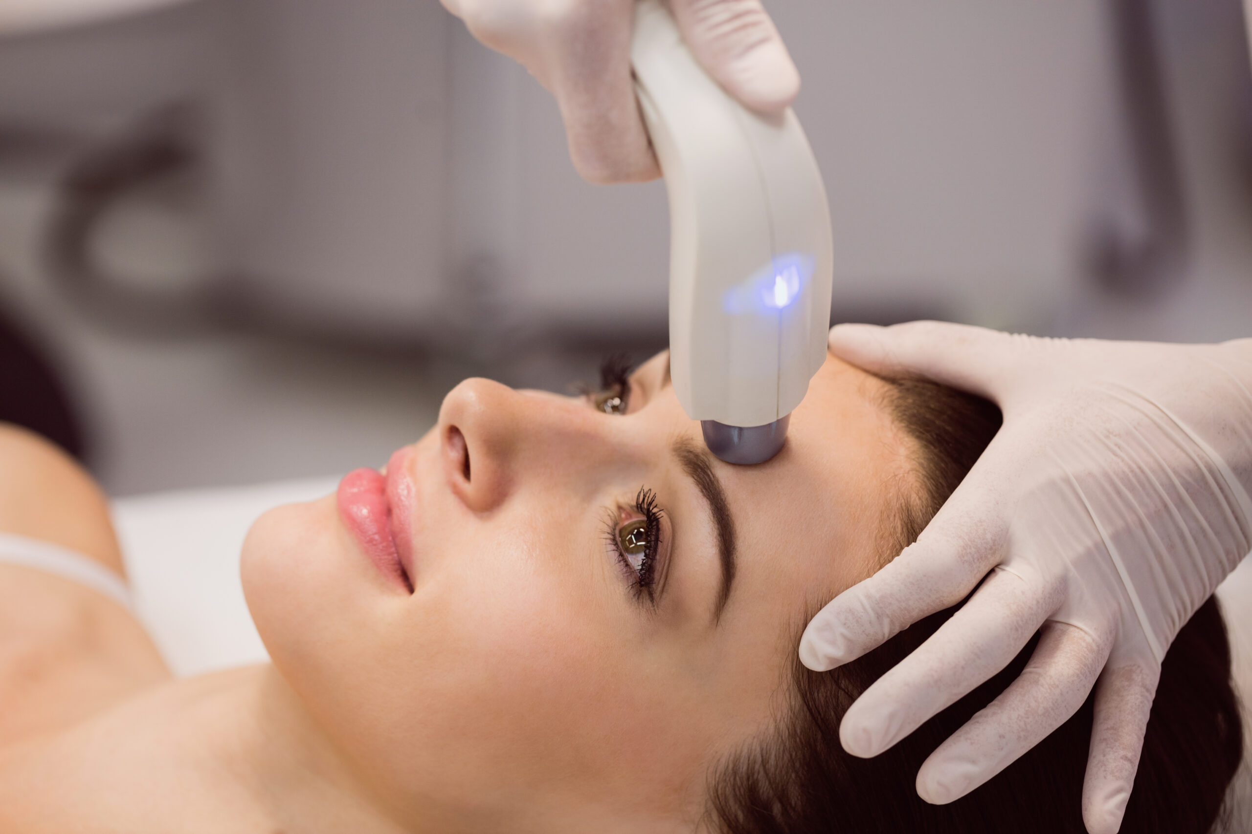 Fractional CO2 laser treatment