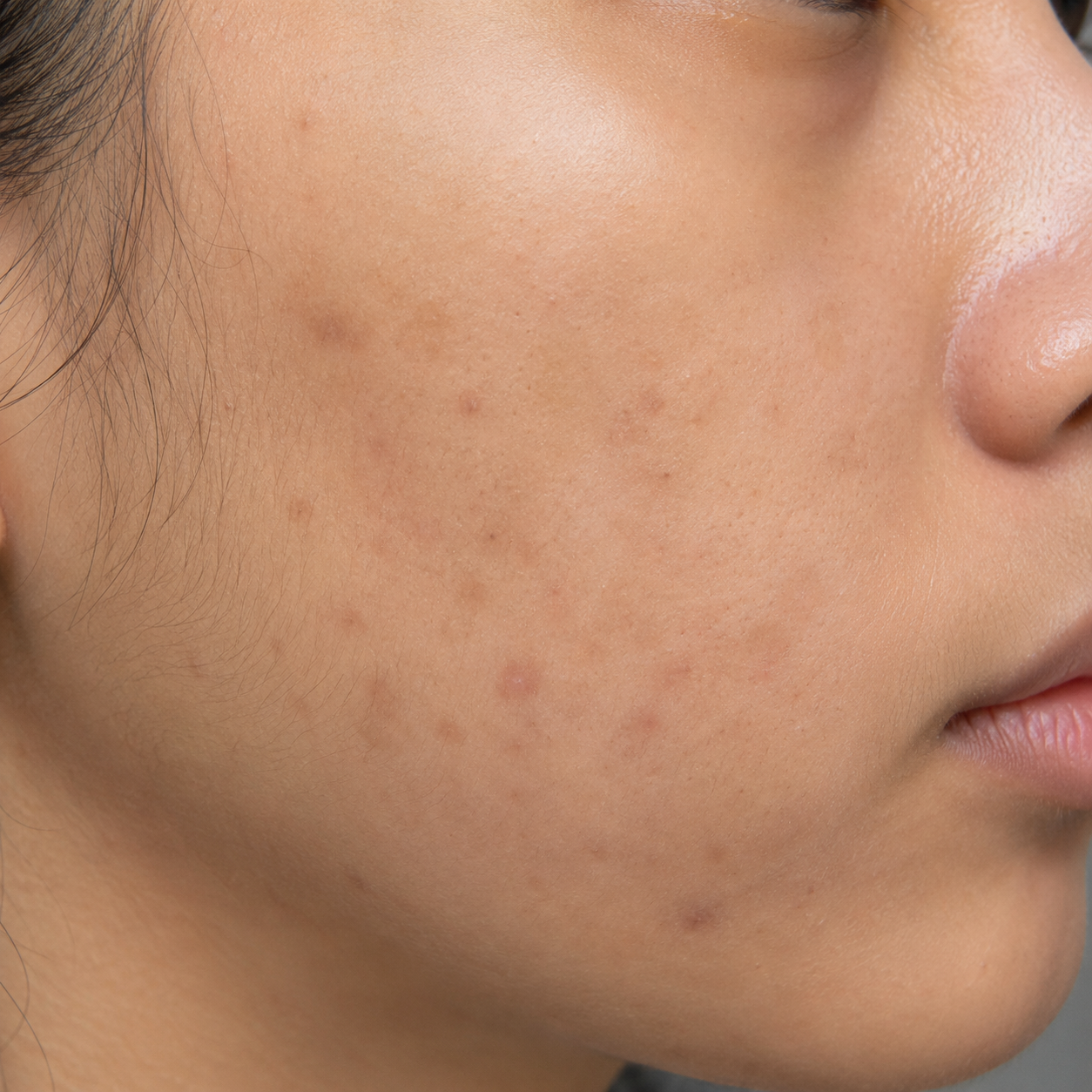 Post-inflammatory pigmentation marks