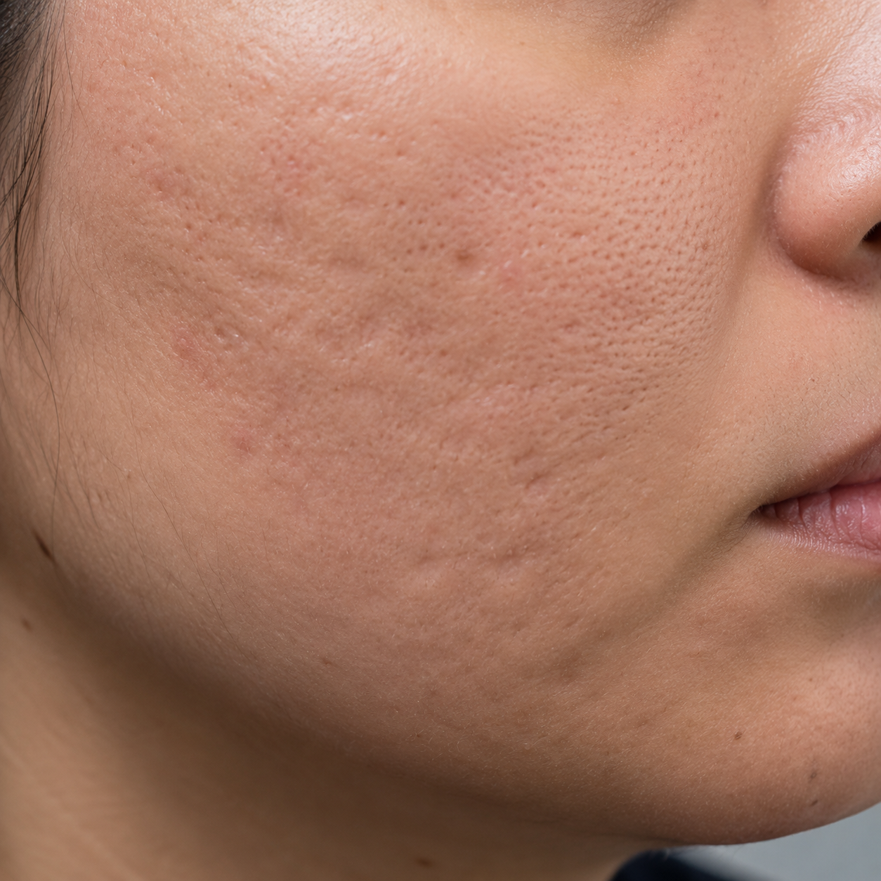 Rolling acne scars on skin