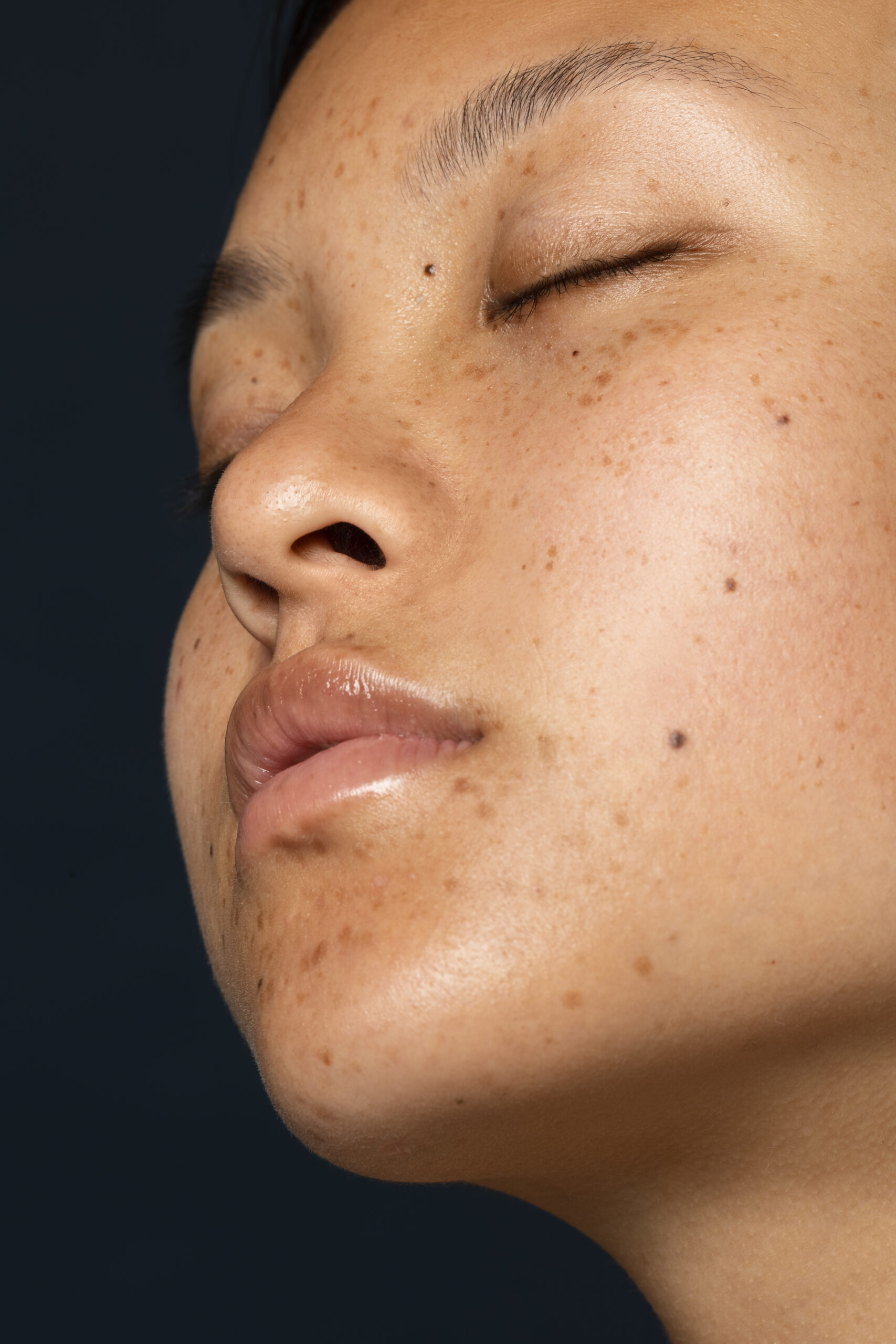 Acne Scar Treatment consultation at Aliva Aesthetics