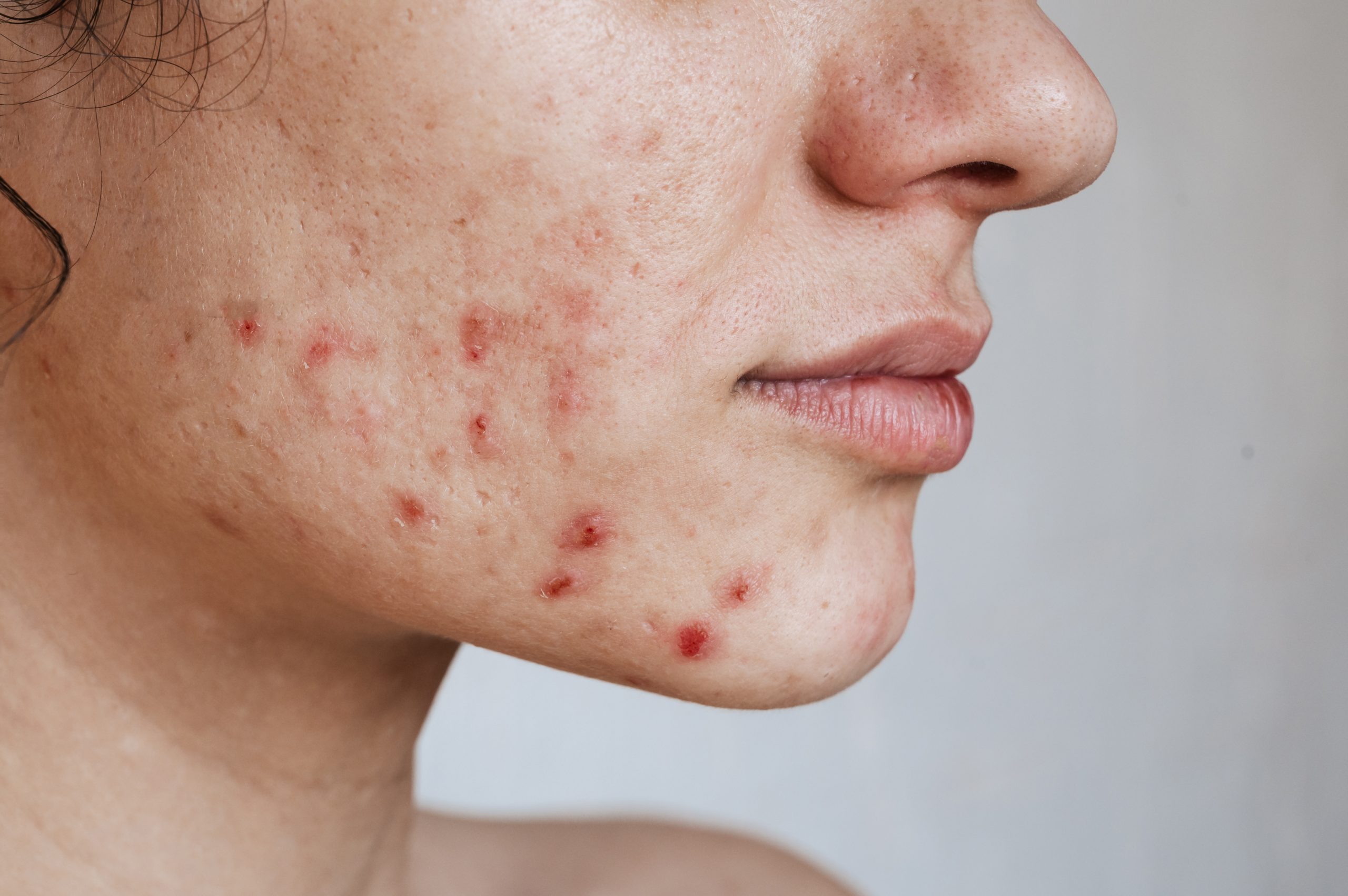 Professional dermatology care for cystic acne