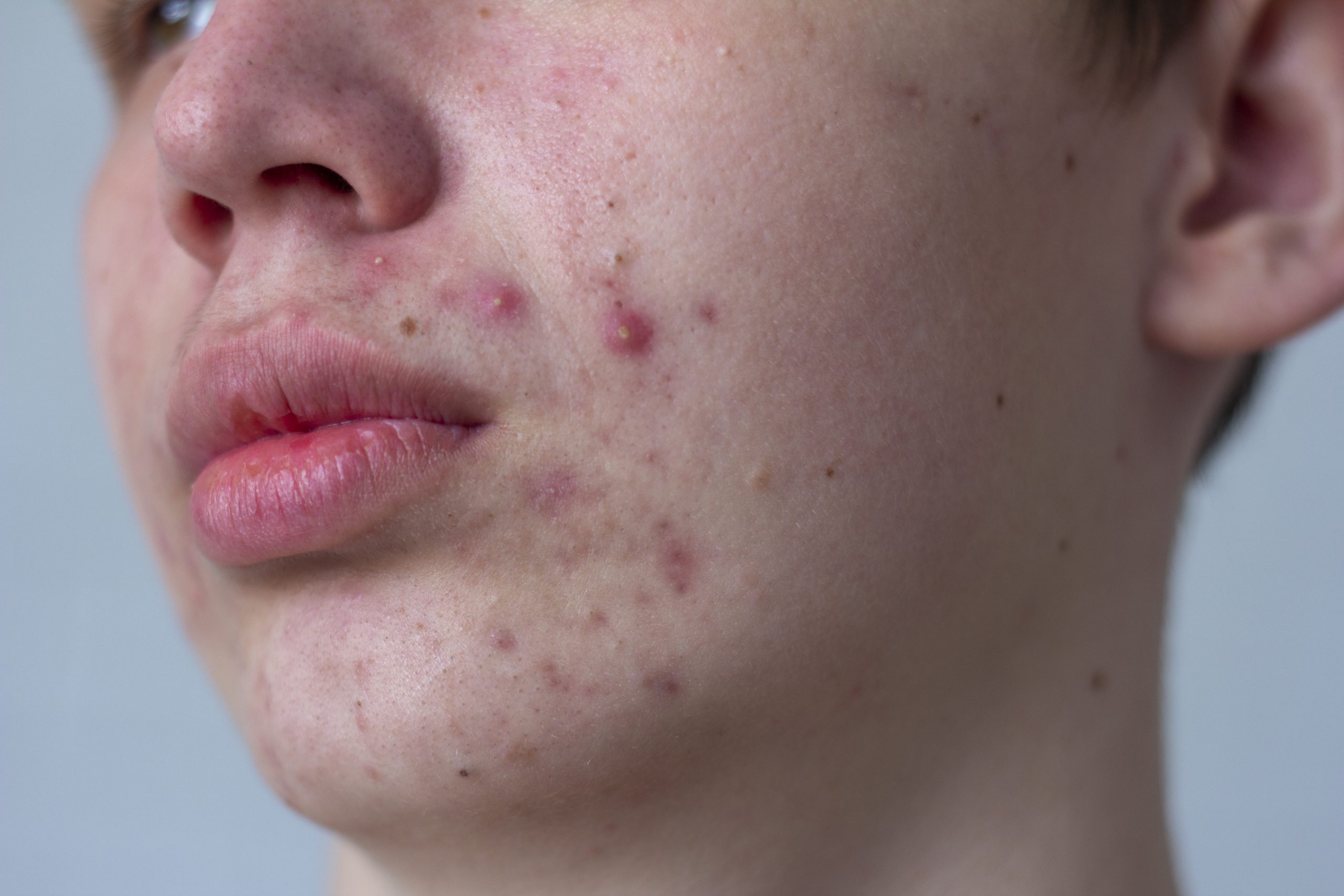 Deep skin therapy for severe acne