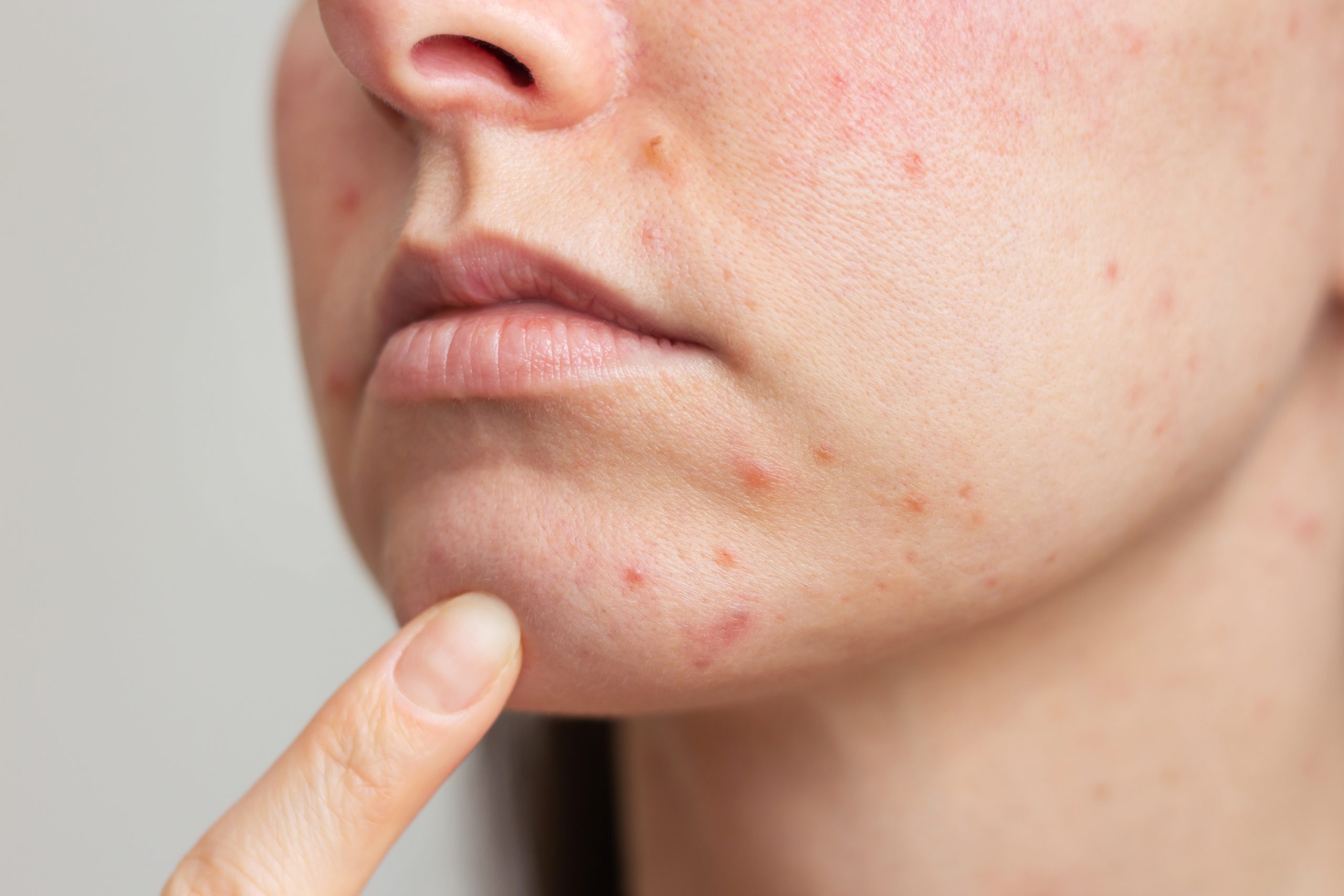 Inflamed sensitive skin