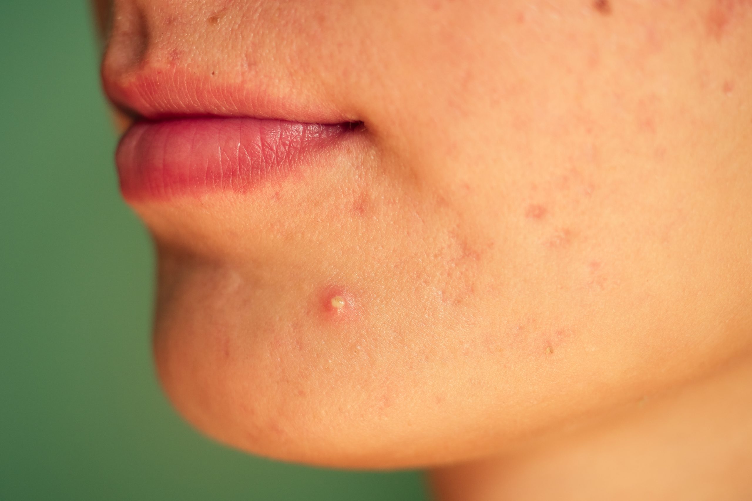 Inflammatory acne treatment